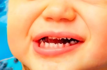 Dientes-de-Hutchinson