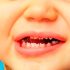 Dientes-de-Hutchinson