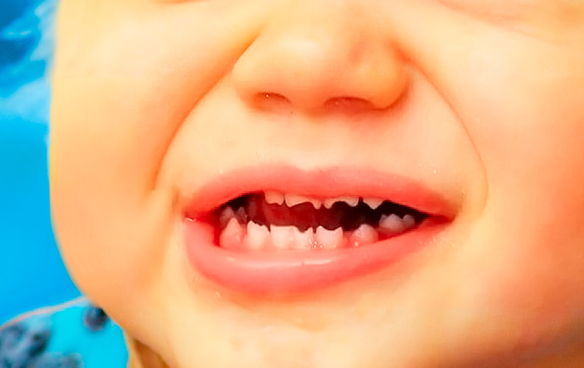 Dientes-de-Hutchinson