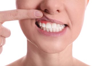 bolsas-periodontales