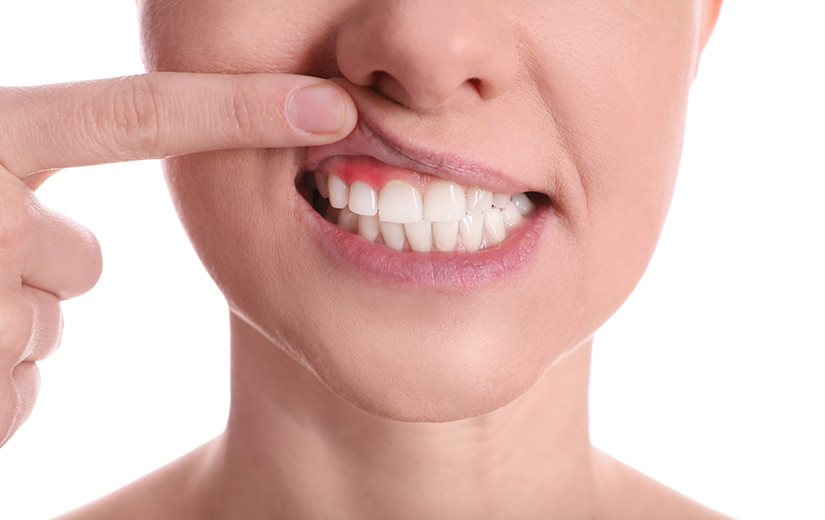 bolsas-periodontales