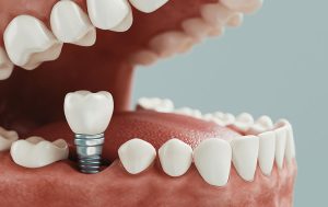 implante dental por infección