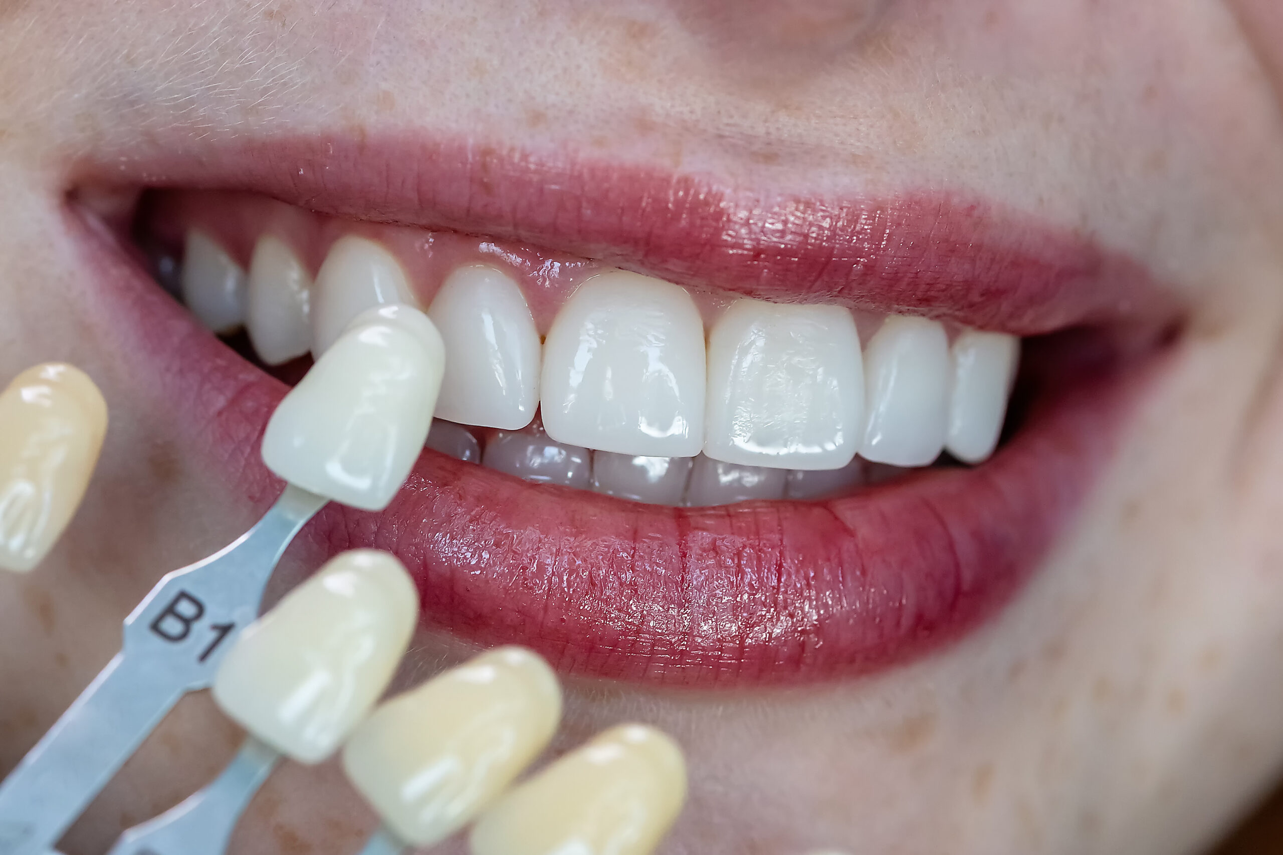 Primer plano de sonrisa con carillas dentales