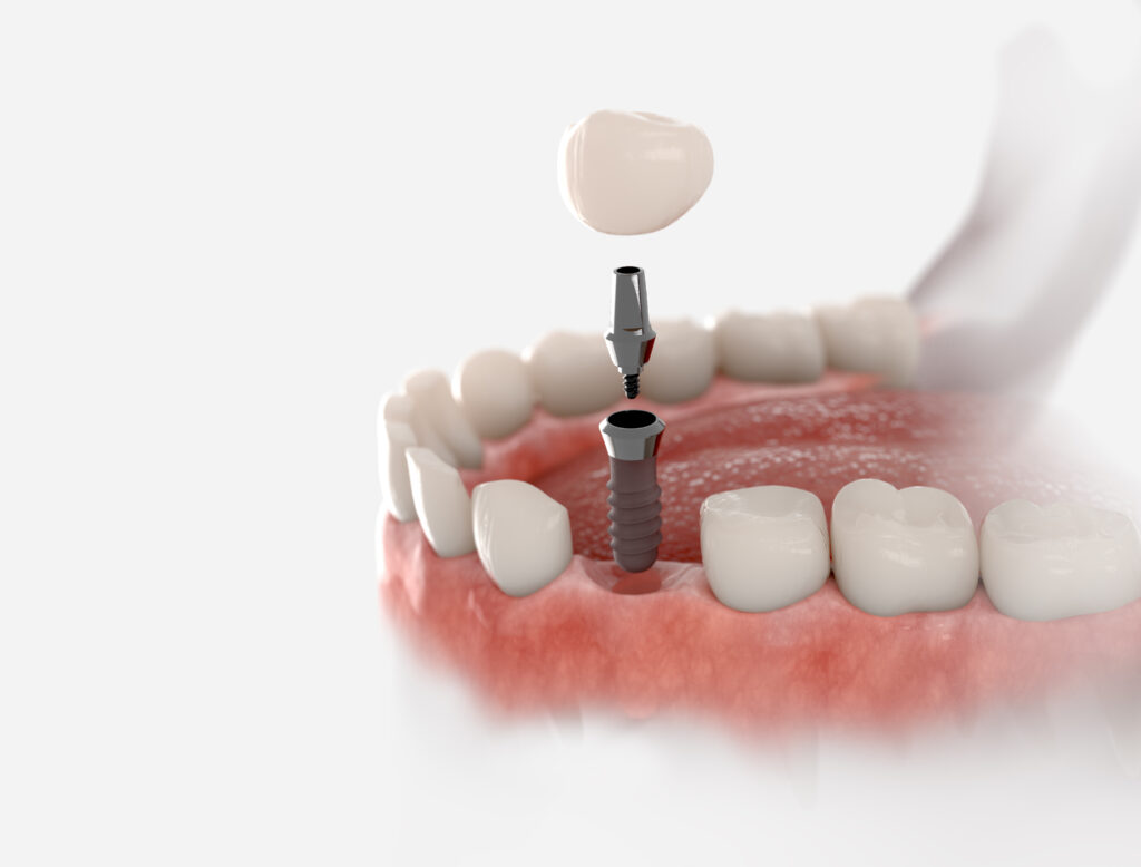 Implante dental colocado en diente inferior