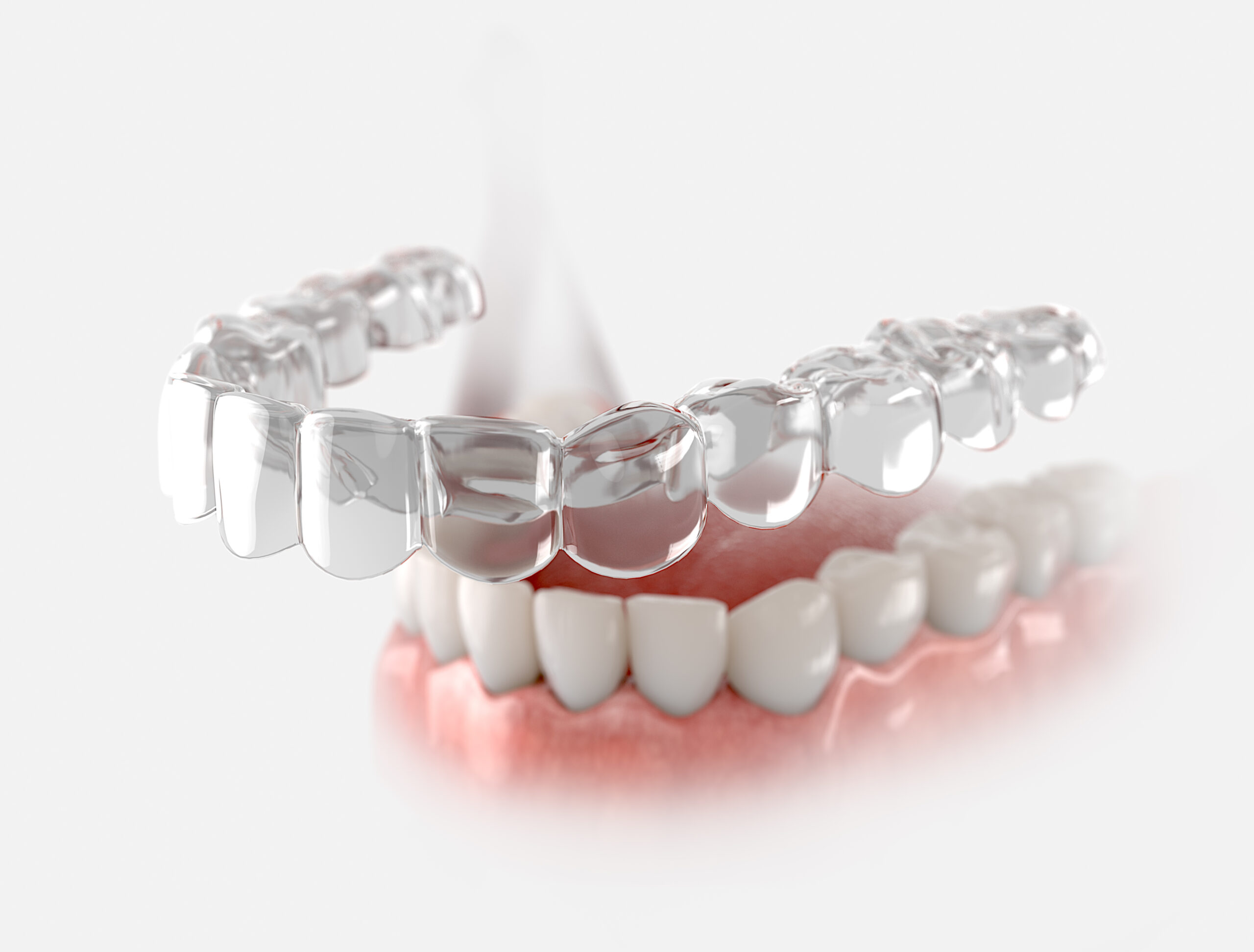 Retenedor dental transparente fijo en la mandíbula inferior tras tratamiento de ortodoncia