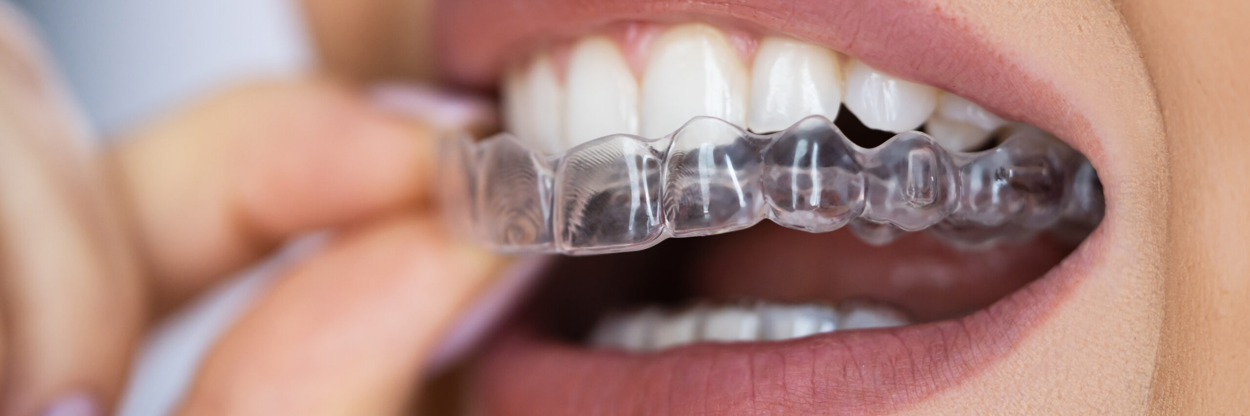 Férula dental transparente de descarga nocturna para protección de dientes