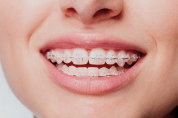 Primer plano de sonrisa con brackets estéticos