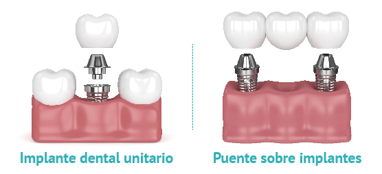 Comparativa entre implante unitario y puente dental como opciones de tratamiento