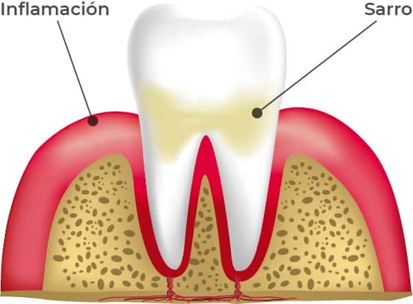 Ilustración detallada de la gingivitis como primera etapa de la enfermedad periodontal