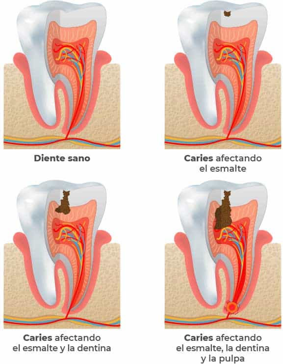 Ilustración de las fases de progresión de la caries dental
