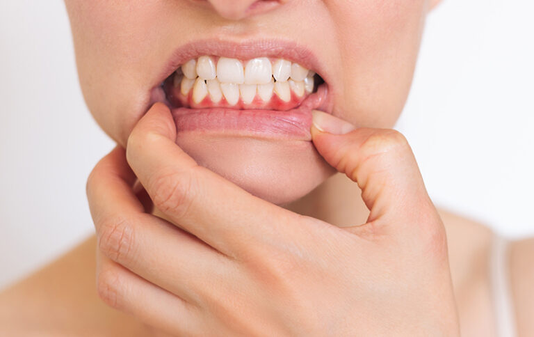 Raspado dental y alisado radicular para tratar la enfermedad periodontal