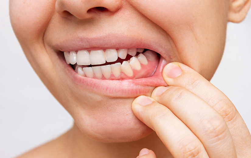 Manos separando encía para mostrar signos de gingivitis