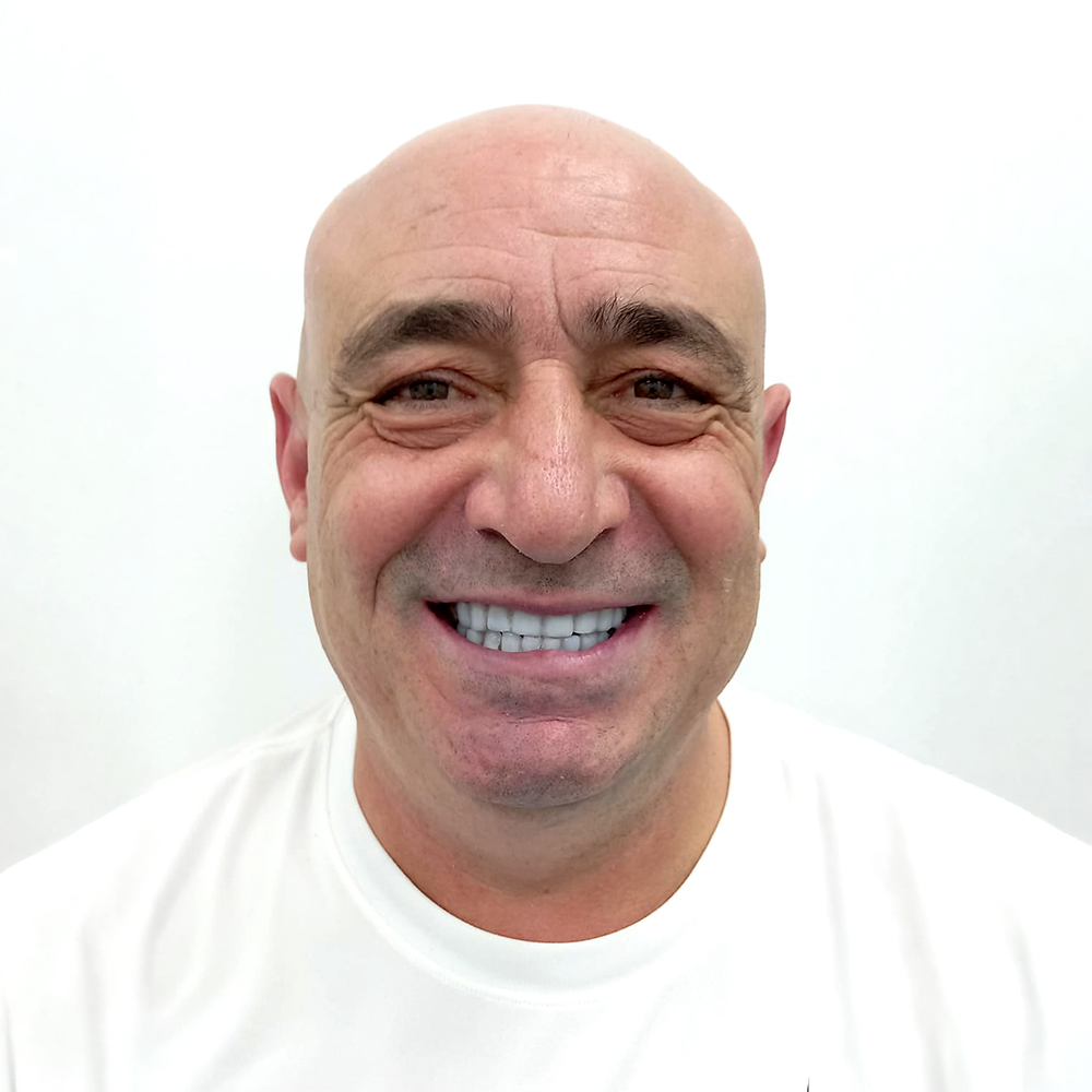 Resultado de tratamiento dental en DentalCompany: antes y después de la sonrisa de un paciente