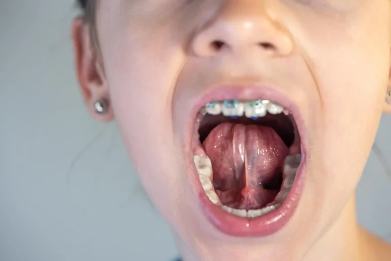 Niña mostrando su anquiloglosia o frenillo lingual corto