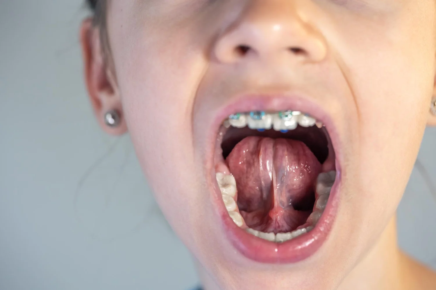 Anquiloglosia: Frenillo lingual corto en niños